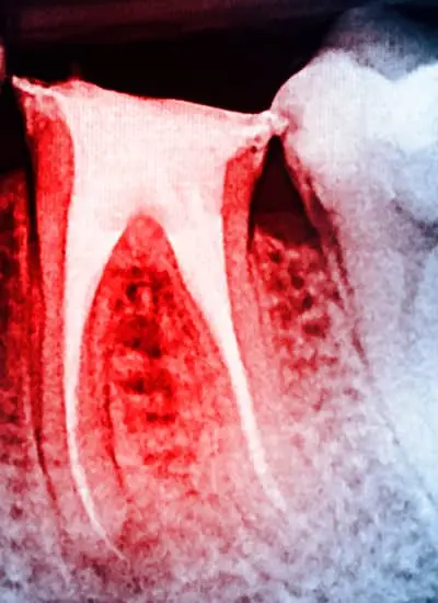 Endodontics - Newmarket Road Dental Clinic
