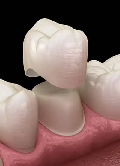 Dental Crowns Norwich - Newmarket Road Dental Clinic