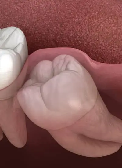 Tooth Extraction - Newmarket Road Dental Clinic