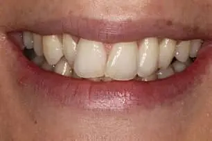 Invisalign before
