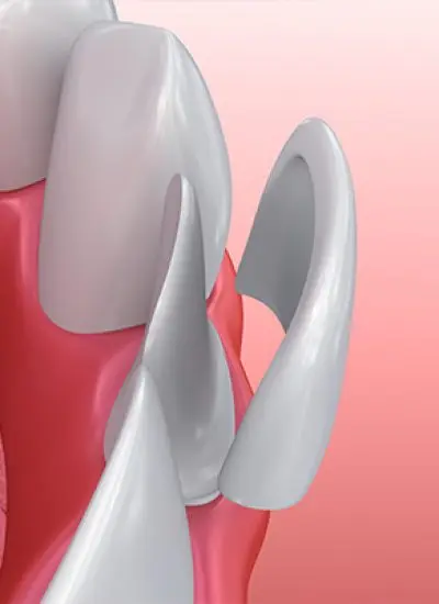 Veneers