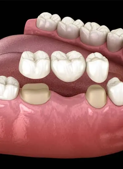 Dental Bridges Norwich - Newmarket Road Dental Clinic
