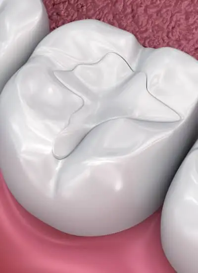 Fillings - Newmarket Road Dental Clinic