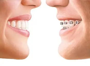 Invisalign norwich