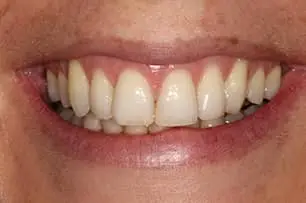 Invisalign after